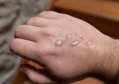 Health machinery in Goa geared for handling Mpox says Dr Betodkar