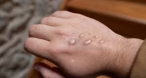 Health machinery in Goa geared for handling Mpox says Dr Betodkar