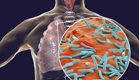 Goa leveraging PPPs to implement advanced technologies for TB elimination