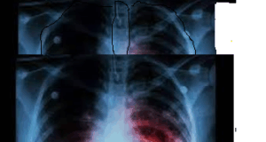 TB-free status is Goa’s next target : CM Sawant