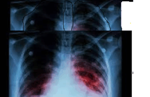 TB-free status is Goa’s next target : CM Sawant