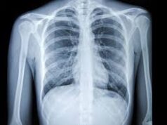 Over 1 lakh chest X-rays screened using AI in Goa; diagnosis time cut by over 50% : Health Minister