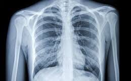 Over 1 lakh chest X-rays screened using AI in Goa; diagnosis time cut by over 50% : Health Minister